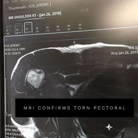 special tests for pectoral tear|pectoralis major rupture mri.